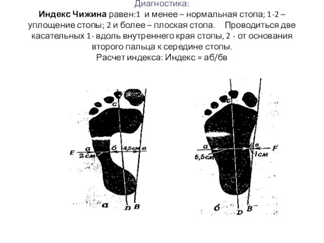 Диагностика: Индекс Чижина равен:1 и менее – нормальная стопа; 1-2 –