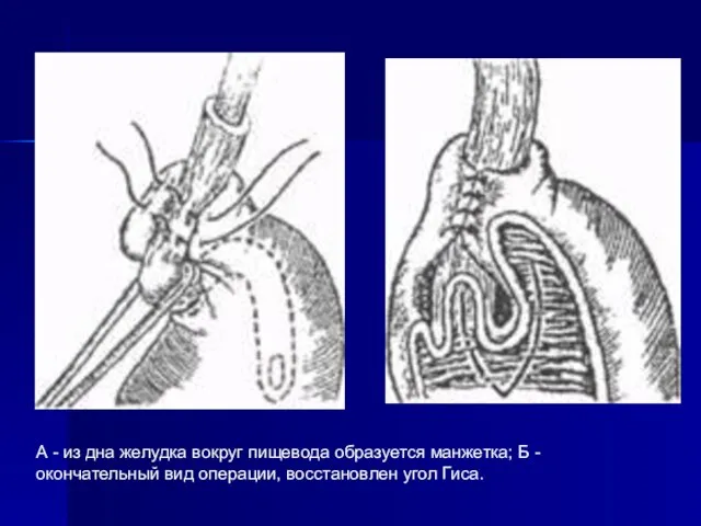 А - из дна желудка вокруг пищевода образуется манжетка; Б -
