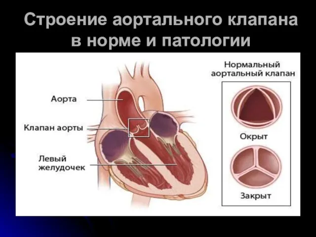 Строение аортального клапана в норме и патологии