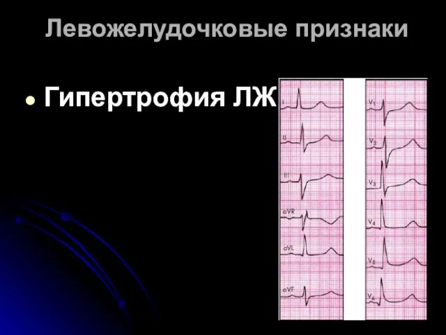 Левожелудочковые признаки Гипертрофия ЛЖ