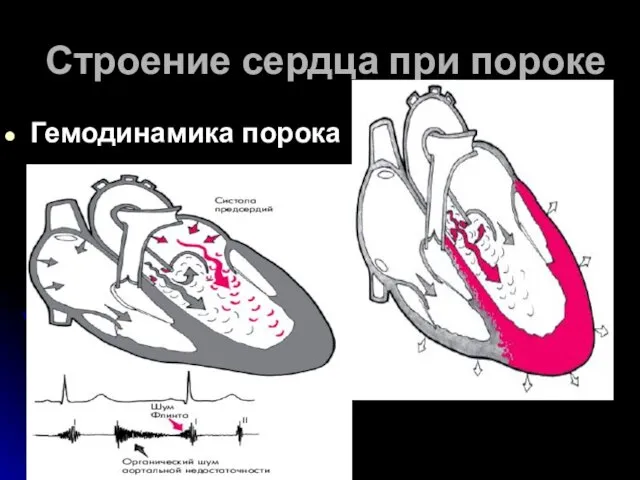 Строение сердца при пороке Гемодинамика порока