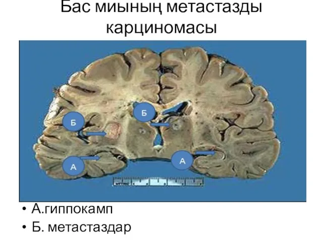 Бас миының метастазды карциномасы А.гиппокамп Б. метастаздар