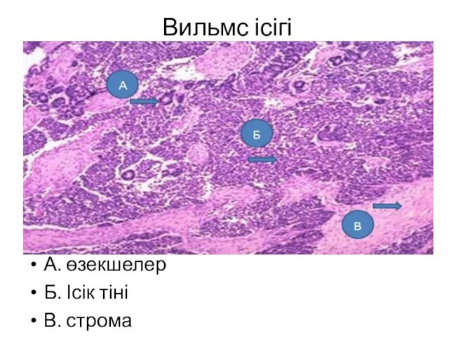 Вильмс ісігі А. өзекшелер Б. Ісік тіні В. строма