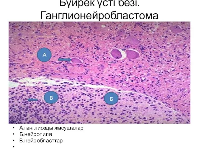 Бүйрек үсті безі. Ганглионейробластома А.ганглиозды жасушалар Б.нейропиля В.нейробласттар