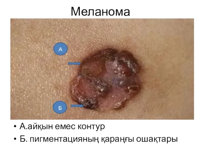 Меланома А.айқын емес контур Б. пигментацияның қараңғы ошақтары