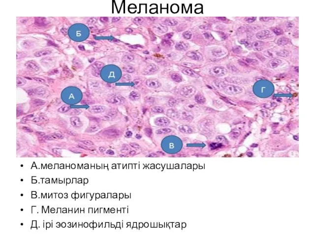 Меланома А.меланоманың атипті жасушалары Б.тамырлар В.митоз фигуралары Г. Меланин пигменті Д. ірі эозинофильді ядрошықтар