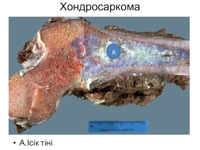 Хондросаркома А.Ісік тіні