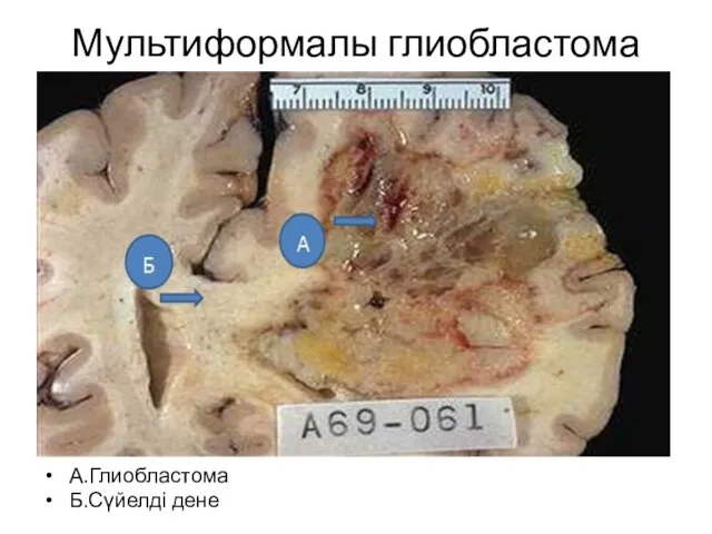 Мультиформалы глиобластома А.Глиобластома Б.Сүйелді дене