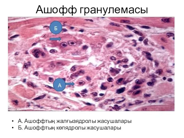 Ашофф гранулемасы А. Ашоффтың жалғызядролы жасушалары Б. Ашоффтың көпядролы жасушалары