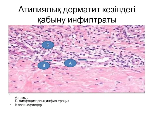 Атипиялық дерматит кезіндегі қабыну инфилтраты А.тамыр Б. лимфоцитарлық инфильтрация В.эозинофилдер В Б А