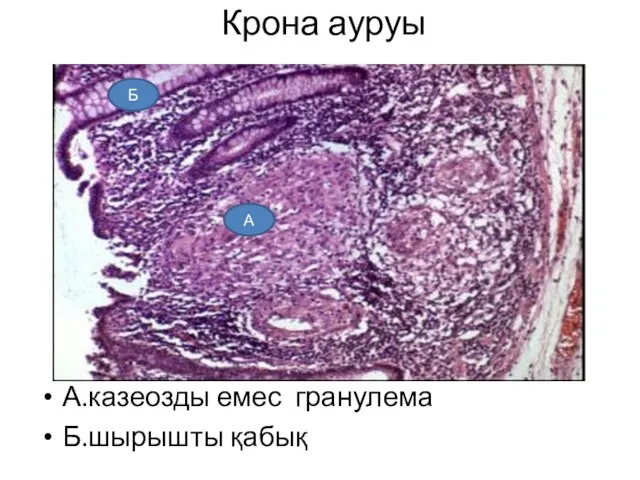 Крона ауруы А.казеозды емес гранулема Б.шырышты қабық Б А