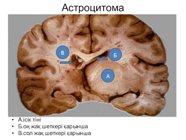 Астроцитома А.ісік тіні Б.оң жақ шеткері қарынша В.сол жақ шеткері қарынша