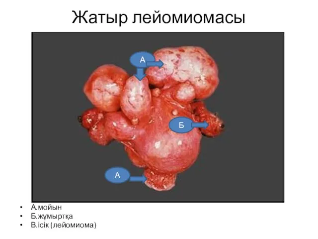 Жатыр лейомиомасы А.мойын Б.жұмыртқа В.ісік (лейомиома) А Б А