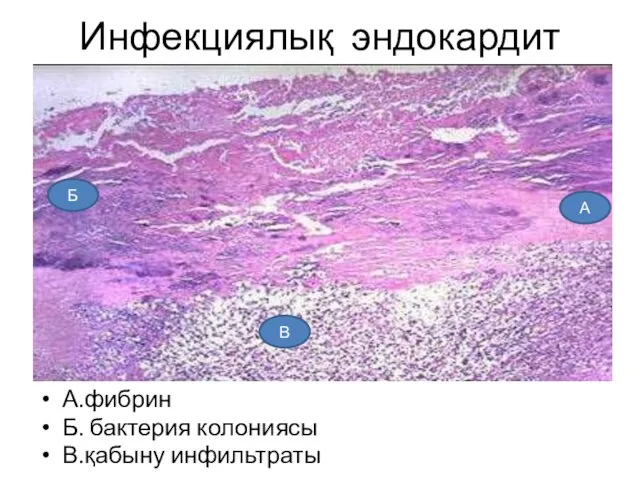 Инфекциялық эндокардит А.фибрин Б. бактерия колониясы В.қабыну инфильтраты Б А В