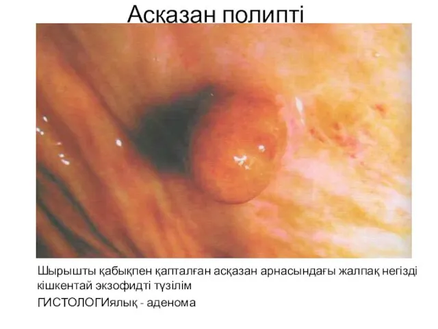 Асқазан полипті Шырышты қабықпен қапталған асқазан арнасындағы жалпақ негізді кішкентай экзофидті түзілім ГИСТОЛОГИялық - аденома