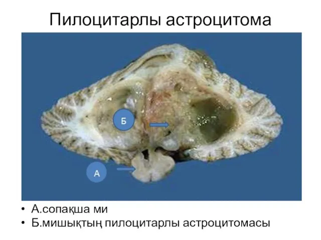 Пилоцитарлы астроцитома А.сопақша ми Б.мишықтың пилоцитарлы астроцитомасы