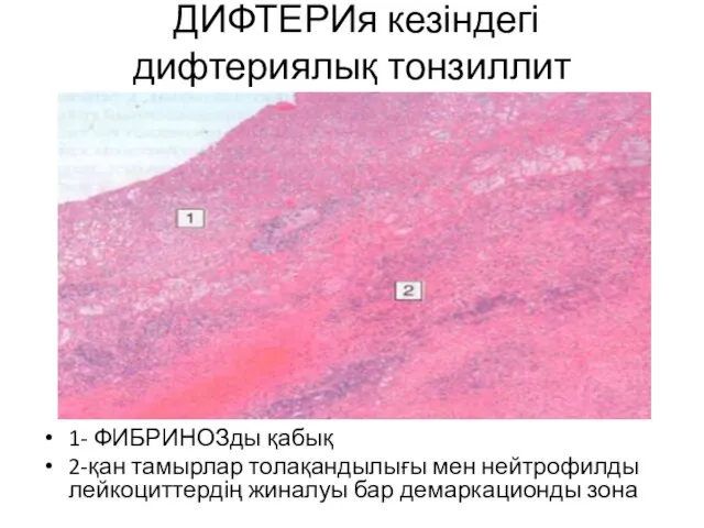 ДИФТЕРИя кезіндегі дифтериялық тонзиллит 1- ФИБРИНОЗды қабық 2-қан тамырлар толақандылығы мен