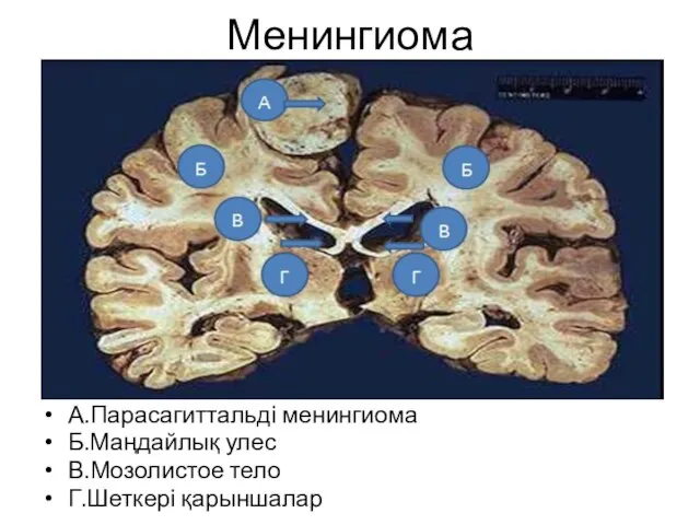 Менингиома А.Парасагиттальді менингиома Б.Маңдайлық улес В.Мозолистое тело Г.Шеткері қарыншалар