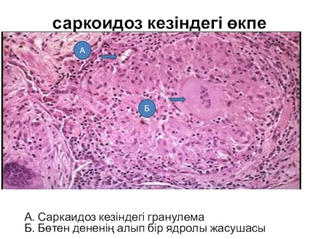 саркоидоз кезіндегі өкпе Б А А. Саркаидоз кезіндегі гранулема Б. Бөтен дененің алып бір ядролы жасушасы