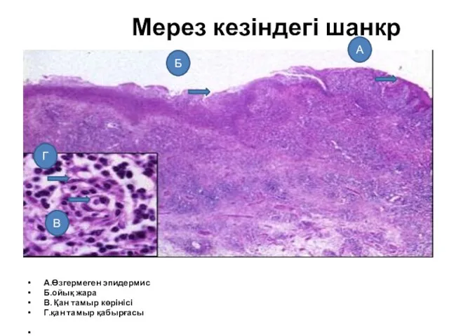 Мерез кезіндегі шанкр А.Өзгермеген эпидермис Б.ойық жара В. Қан тамыр көрінісі