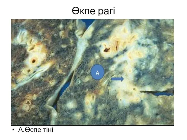 Өкпе рагі А.Өспе тіні