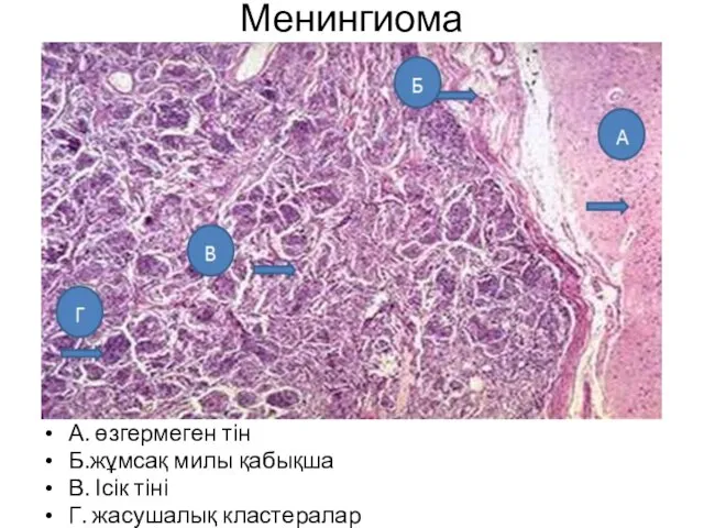 Менингиома А. өзгермеген тін Б.жұмсақ милы қабықша В. Ісік тіні Г. жасушалық кластералар