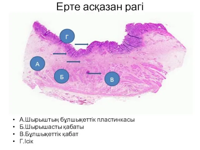 Ерте асқазан рагі А.Шырыштың бұлшықеттік пластинкасы Б.Шырышасты қабаты В.Бұлшықеттік қабат Г.Ісік