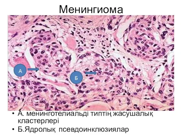 Менингиома А. менинготелиальді типтің жасушалық кластерлері Б.Ядролық псевдоинклюзиялар