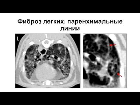 Фиброз легких: паренхимальные линии