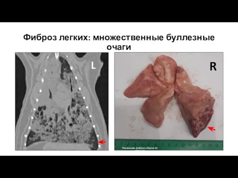 Фиброз легких: множественные буллезные очаги R Пневмония, фиброз к.бирма 9л ЛЮСИК