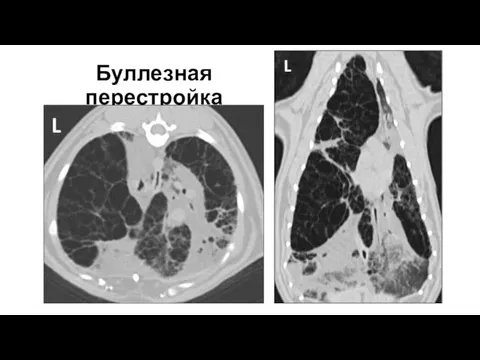 Буллезная перестройка