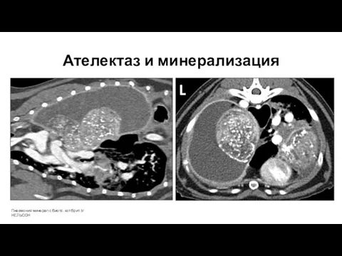 Ателектаз и минерализация Пневмония минерал с биопс. кот брит 3г НЕЛЬСОН