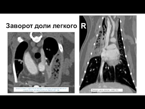 Заворот доли легкого Заворот доли, воспал. к.мет 15л ДАНЯ Seiler G,