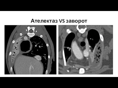 Ателектаз VS заворот