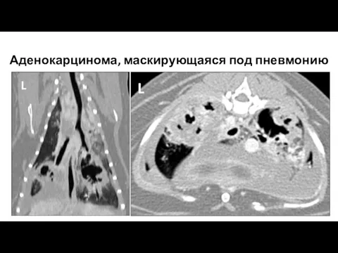 Аденокарцинома, маскирующаяся под пневмонию