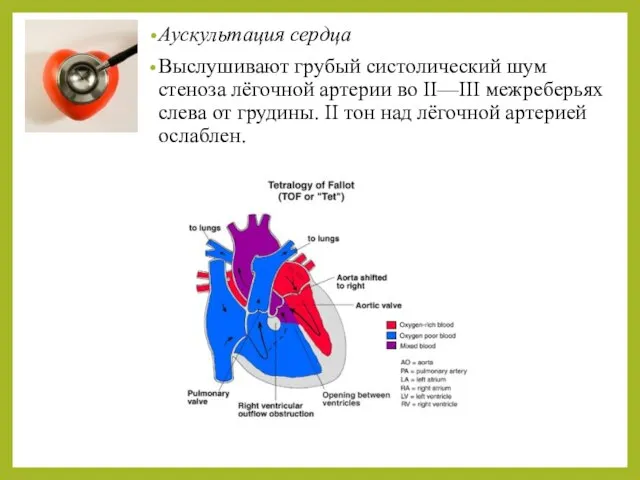 Аускультация сердца Выслушивают грубый систолический шум стеноза лёгочной артерии во II—III