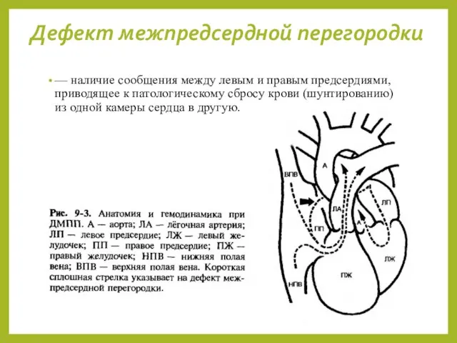 Дефект межпредсердной перегородки — наличие сообщения между левым и правым предсердиями,