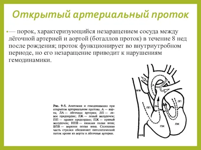 Открытый артериальный проток — порок, характеризующийся незаращением сосуда между лёгочной артерией