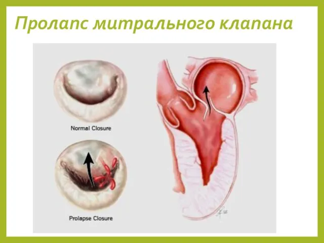 Пролапс митрального клапана