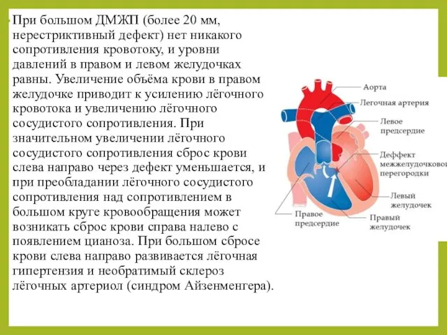 При большом ДМЖП (более 20 мм, нерестриктивный дефект) нет никакого сопротивления