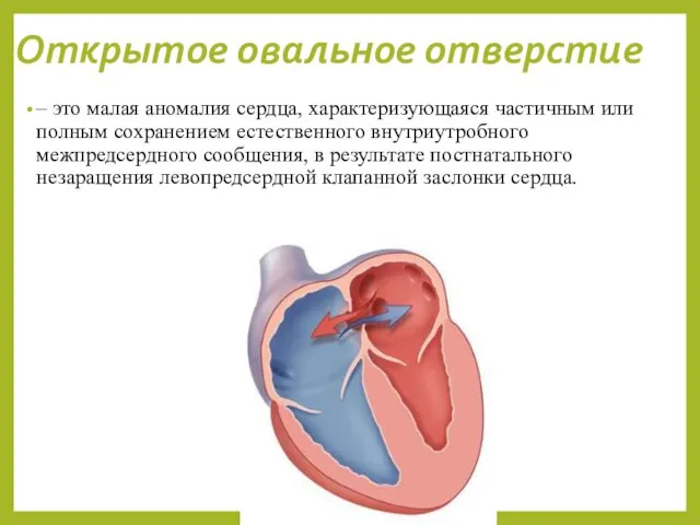 Открытое овальное отверстие – это малая аномалия сердца, характеризующаяся частичным или