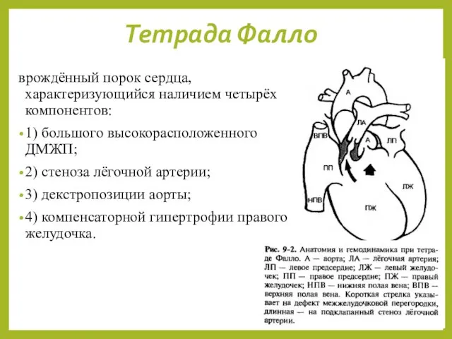 Тетрада Фалло врождённый порок сердца, характеризующийся наличием четырёх компонентов: 1) большого