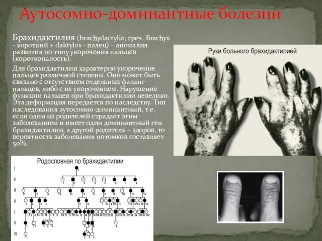 Аутосомно-доминантные болезни Брахидактилия (brachydactylia; греч. Brachys - короткий + daktylos -