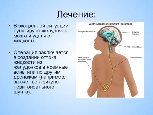 Лечение: В экстренной ситуации пунктируют желудочек мозга и удаляют жидкость. Операция