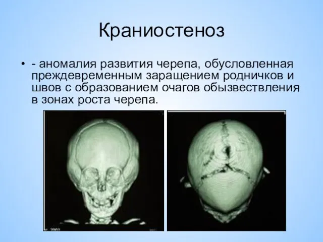 Краниостеноз - аномалия развития черепа, обусловленная преждевременным заращением родничков и швов