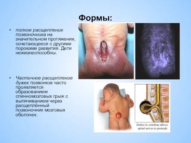 Формы: полное расщепление позвоночника на значительном протяжении, сочетающееся с другими пороками