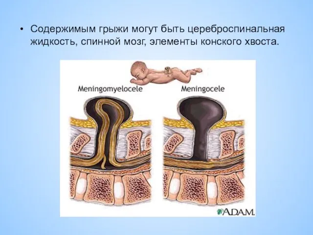 Содержимым грыжи могут быть цереброспинальная жидкость, спинной мозг, элементы конского хвоста.