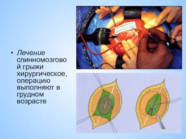 Лечение спинномозговой грыжи хирургическое, операцию выполняют в грудном возрасте