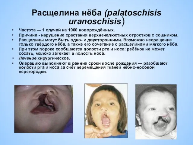 Расщелина нёба (palatoschisis uranoschisis) Частота — 1 случай на 1000 новорождённых.