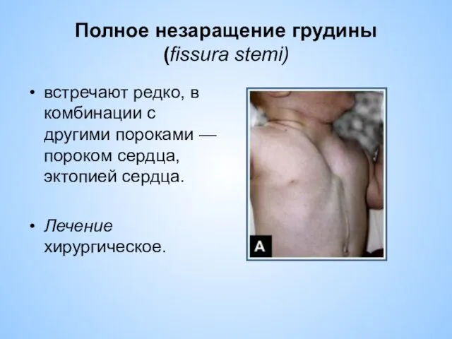 Полное незаращение грудины (fissura stemi) встречают редко, в комбинации с другими